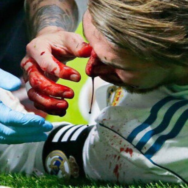 Sergio Ramos nariz rota @sergioramos