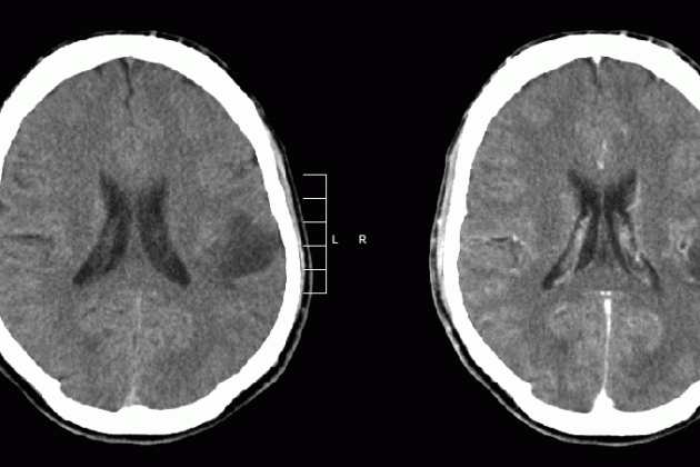 Glioma