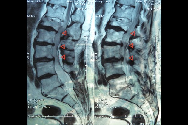 Estenosis lumbar