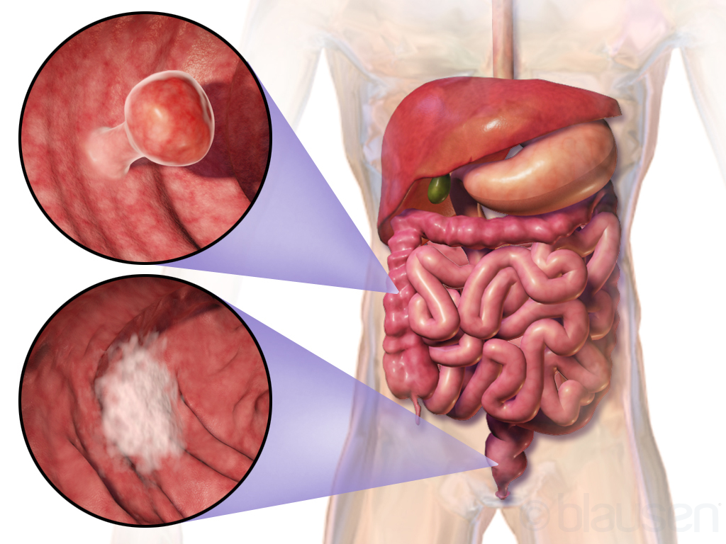 Cáncer colorrectal