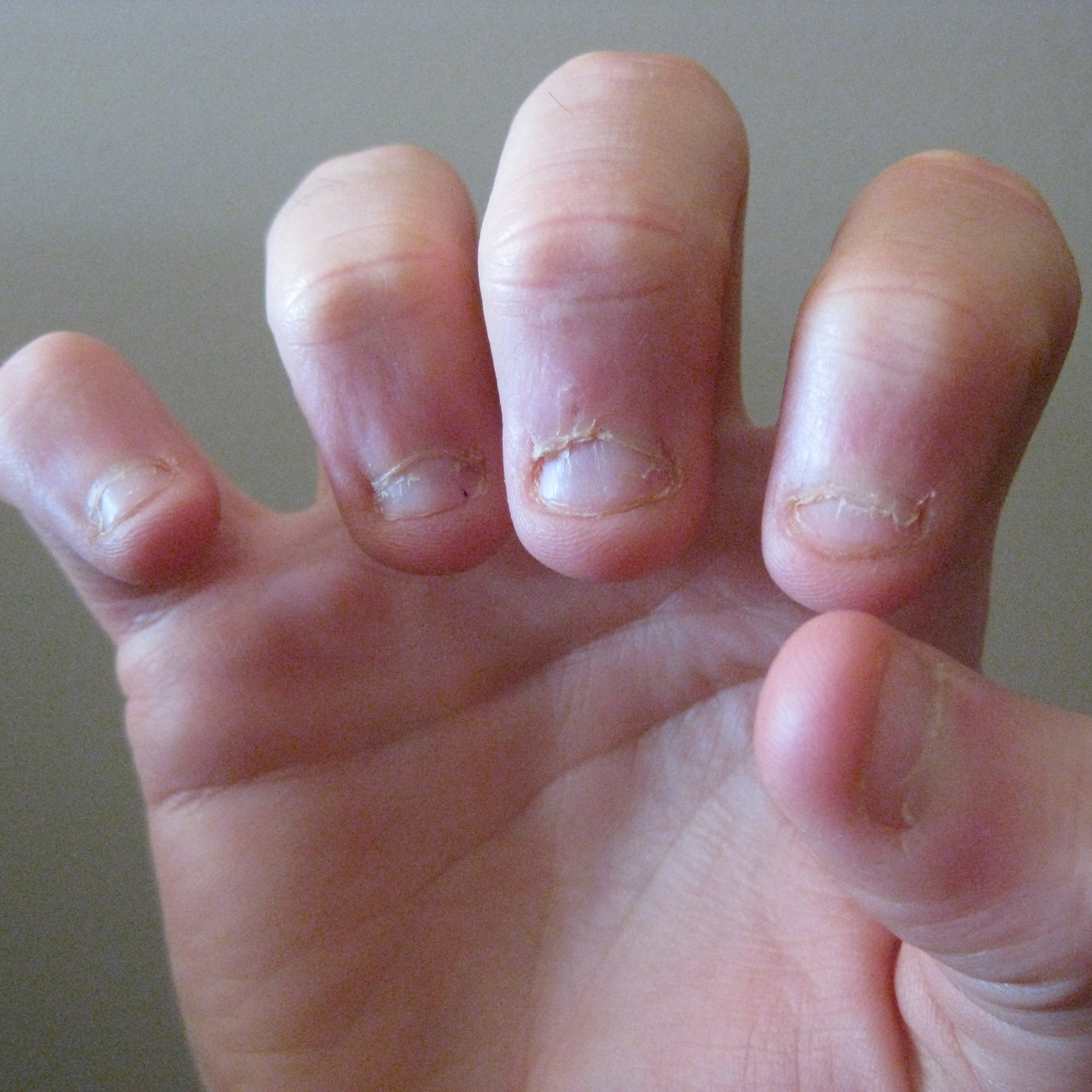 Por qué nos mordemos las uñas y qué hacer para evitarlo