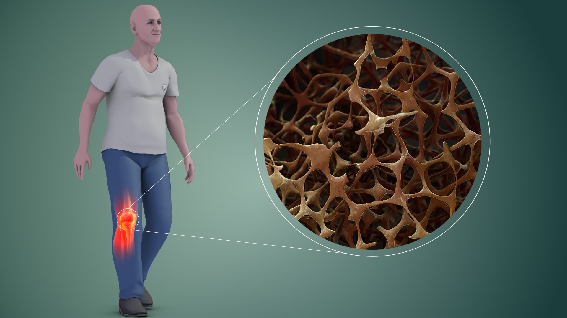 Osteoporosi genoll
