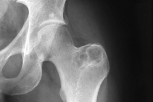 Sarcoma pelvis