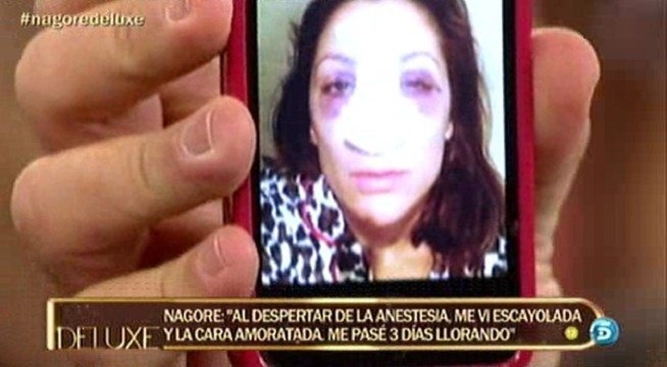 Nagore Robles operacio nariz rinoplastia Telecinco