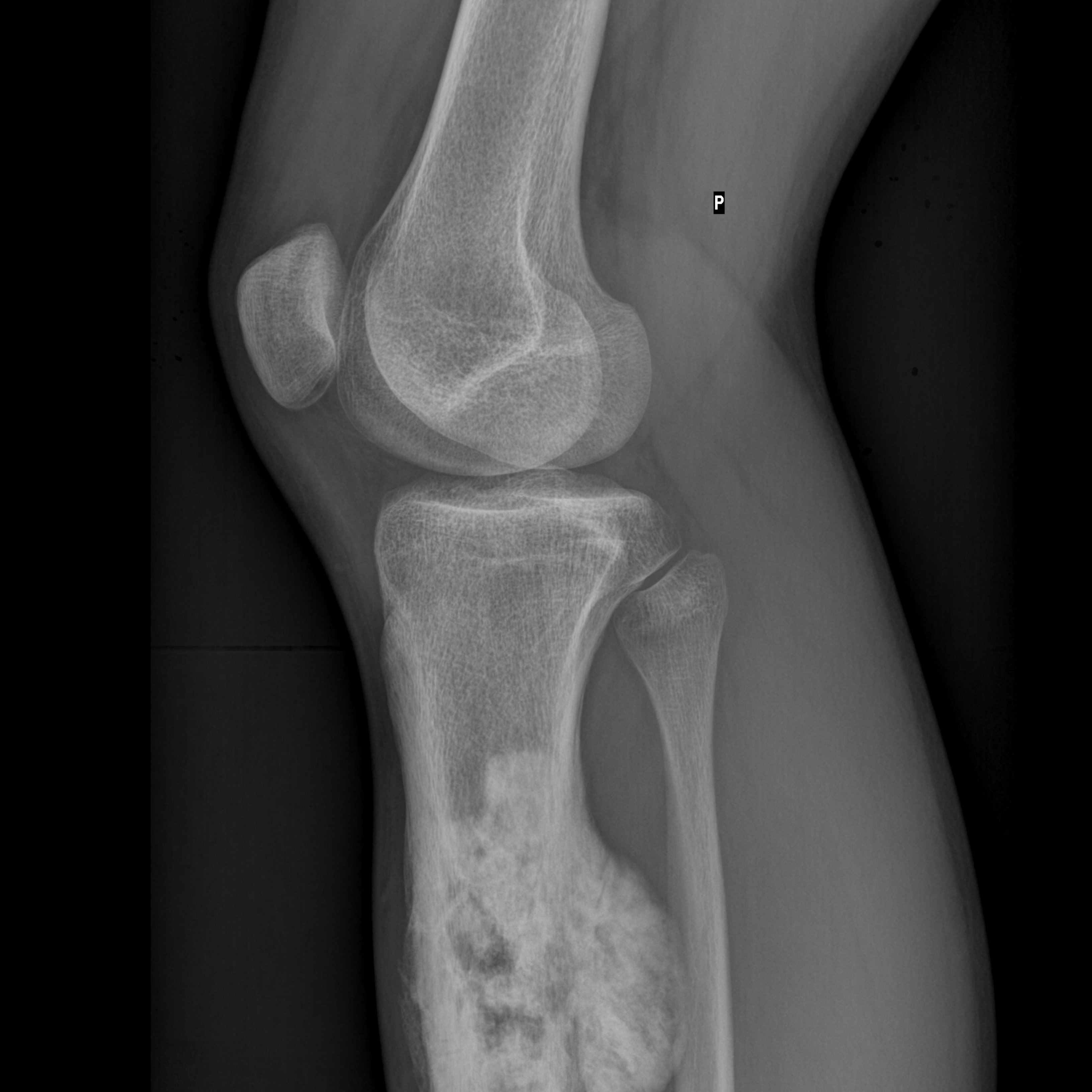 Troben els gens que afavoreixen el desenvolupament de l'osteosarcoma