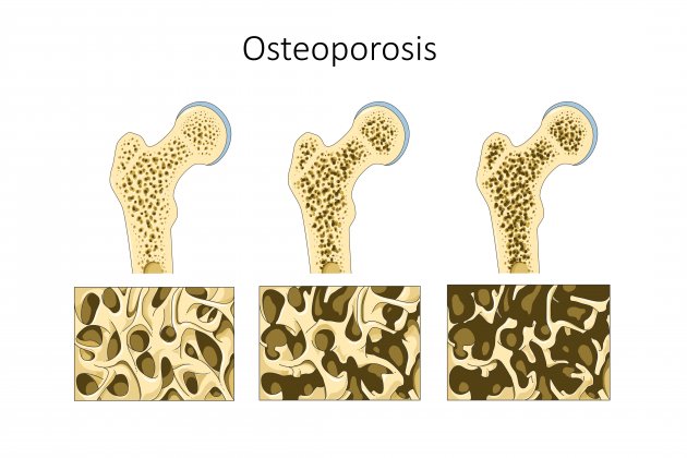 Osteoporosis (1)