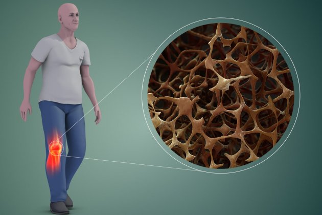 Osteoporosis hombre (1)