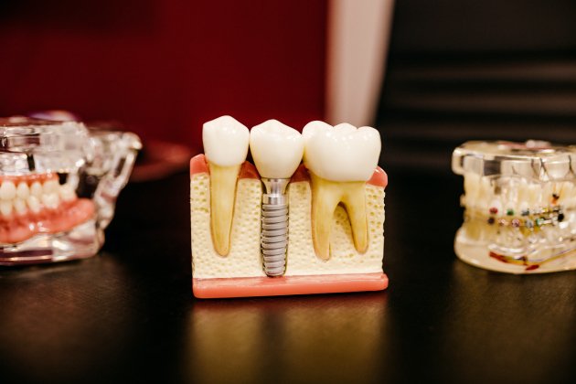 dents implants unsplash