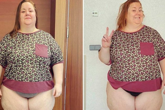 Castro lipedema