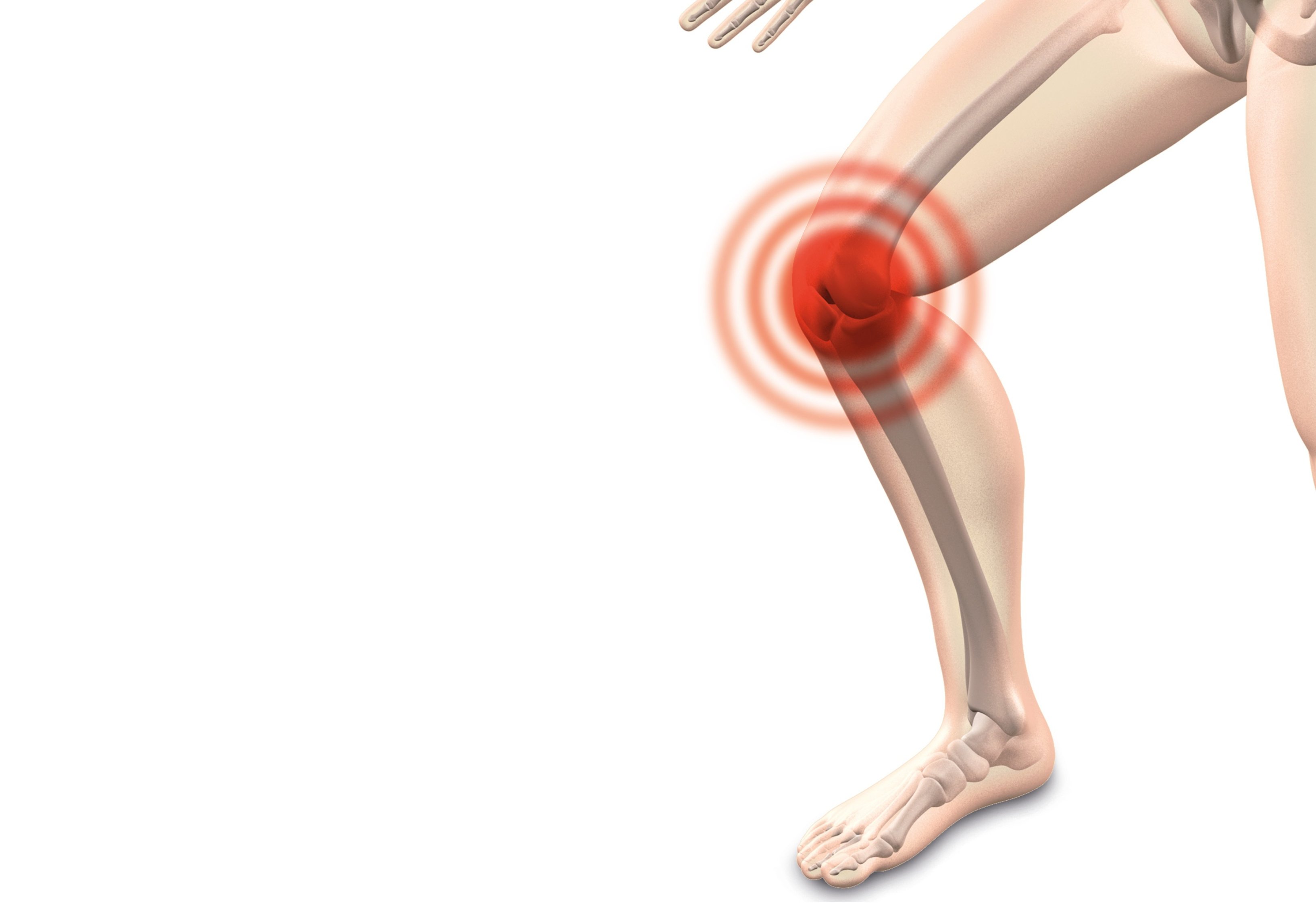 Dolor de rodilla por artrosis