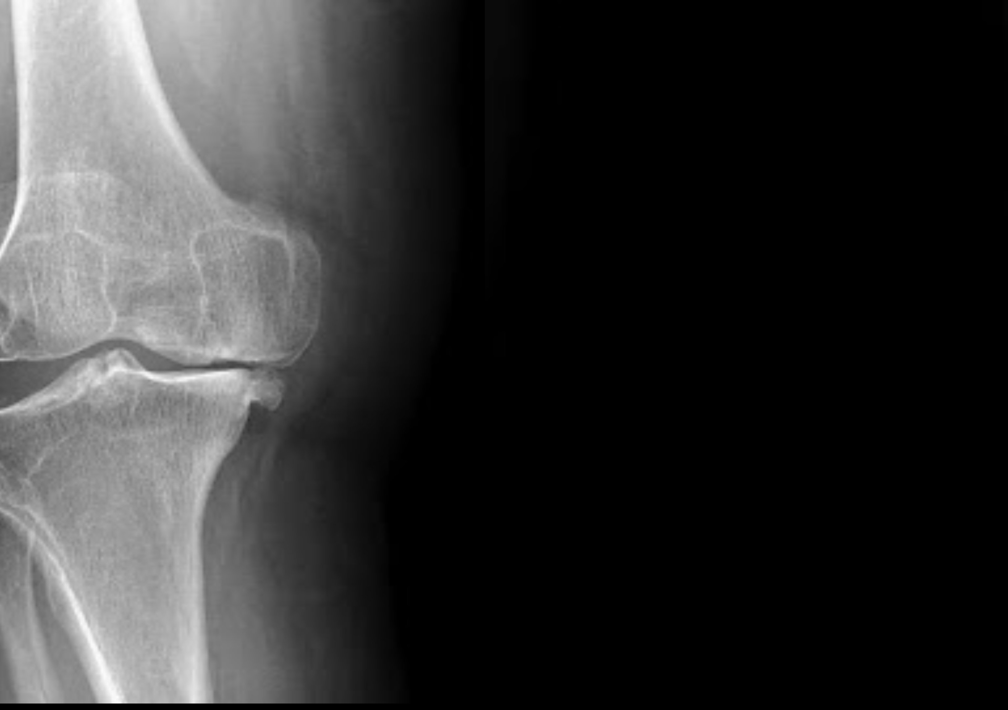 Radiografía de rodilla con artrosis