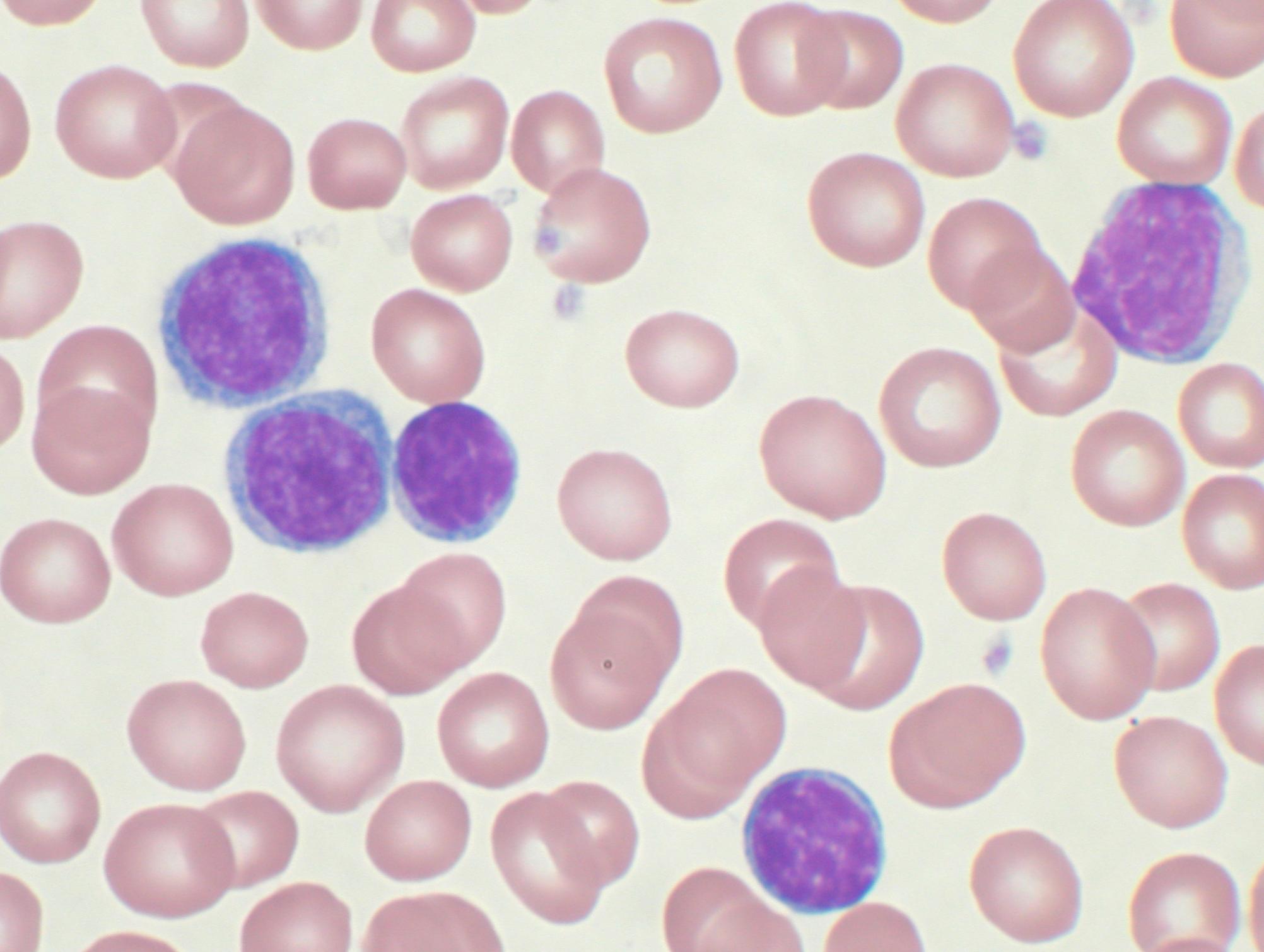 Leucemia