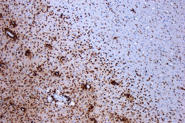 Esclerósis múltiple Esclerósis múltiple