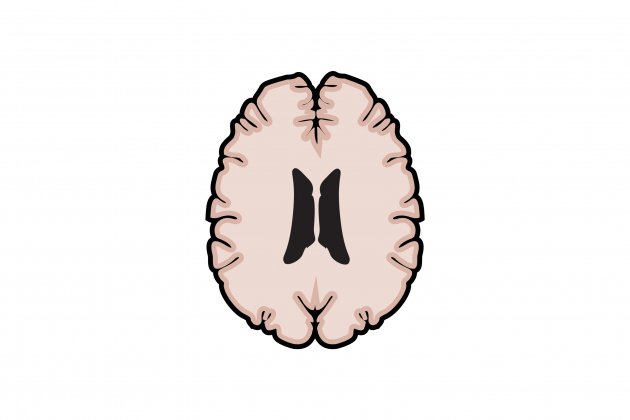 Tall|Cort del cervell amb esclerosi múltiple