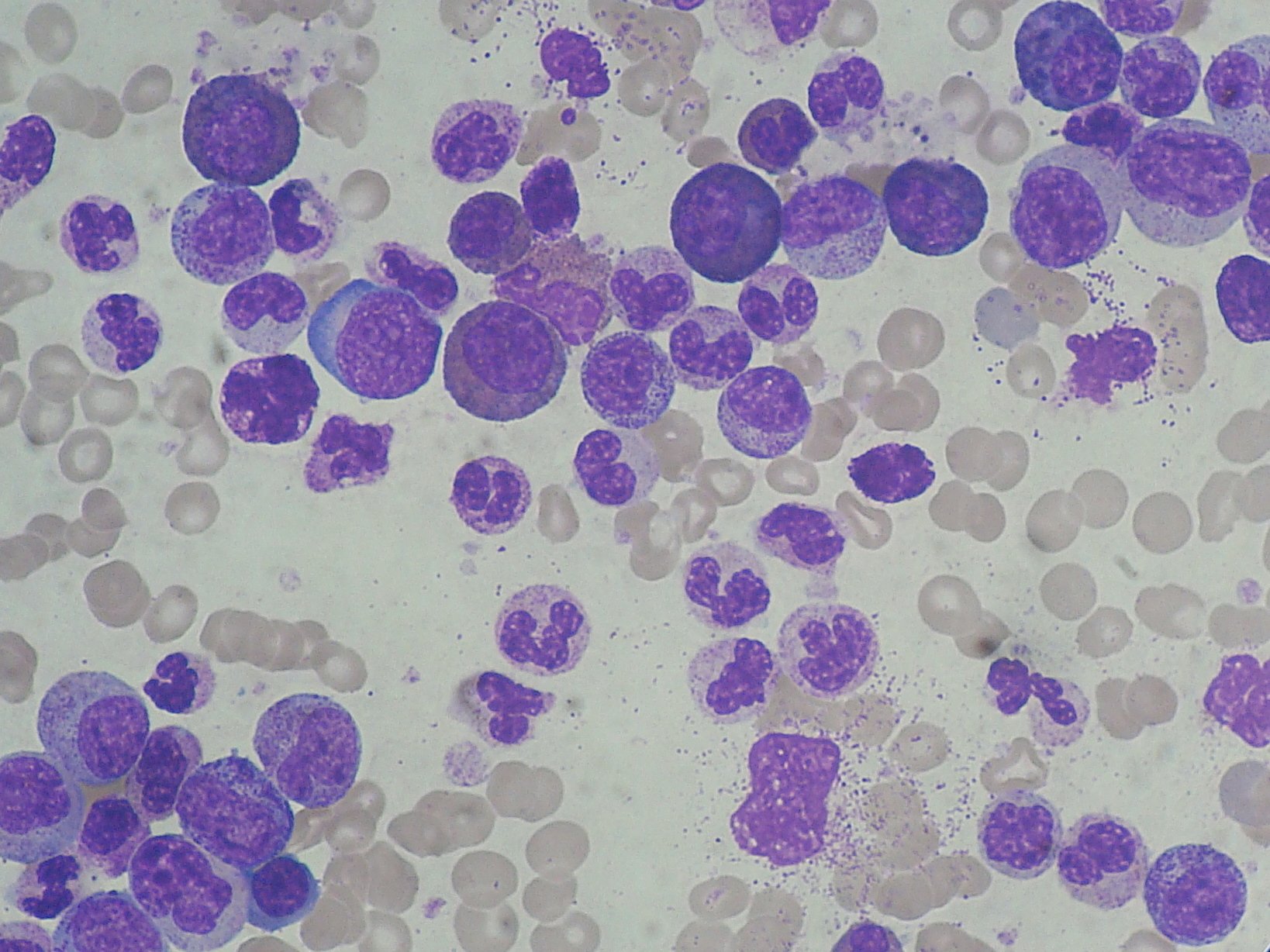 Leucemia mieloide al microscopio