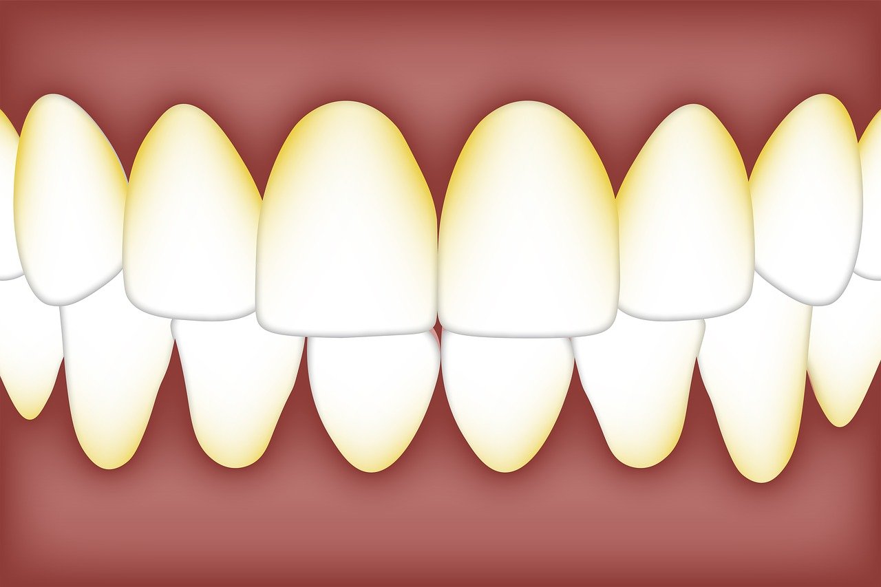Placa dental