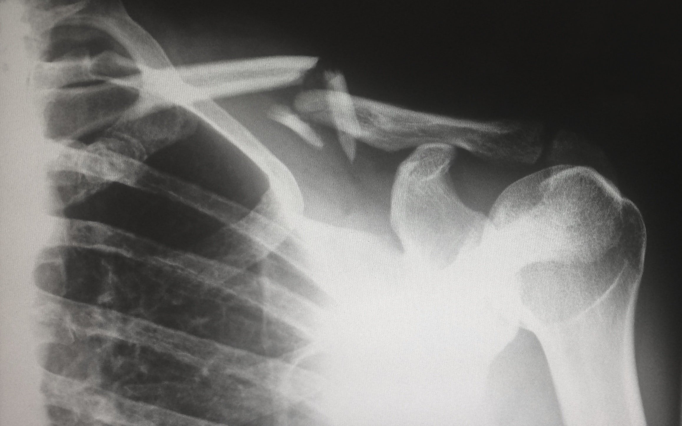 Osteoporosi: com protegir i evitar que es trenquin els ossos