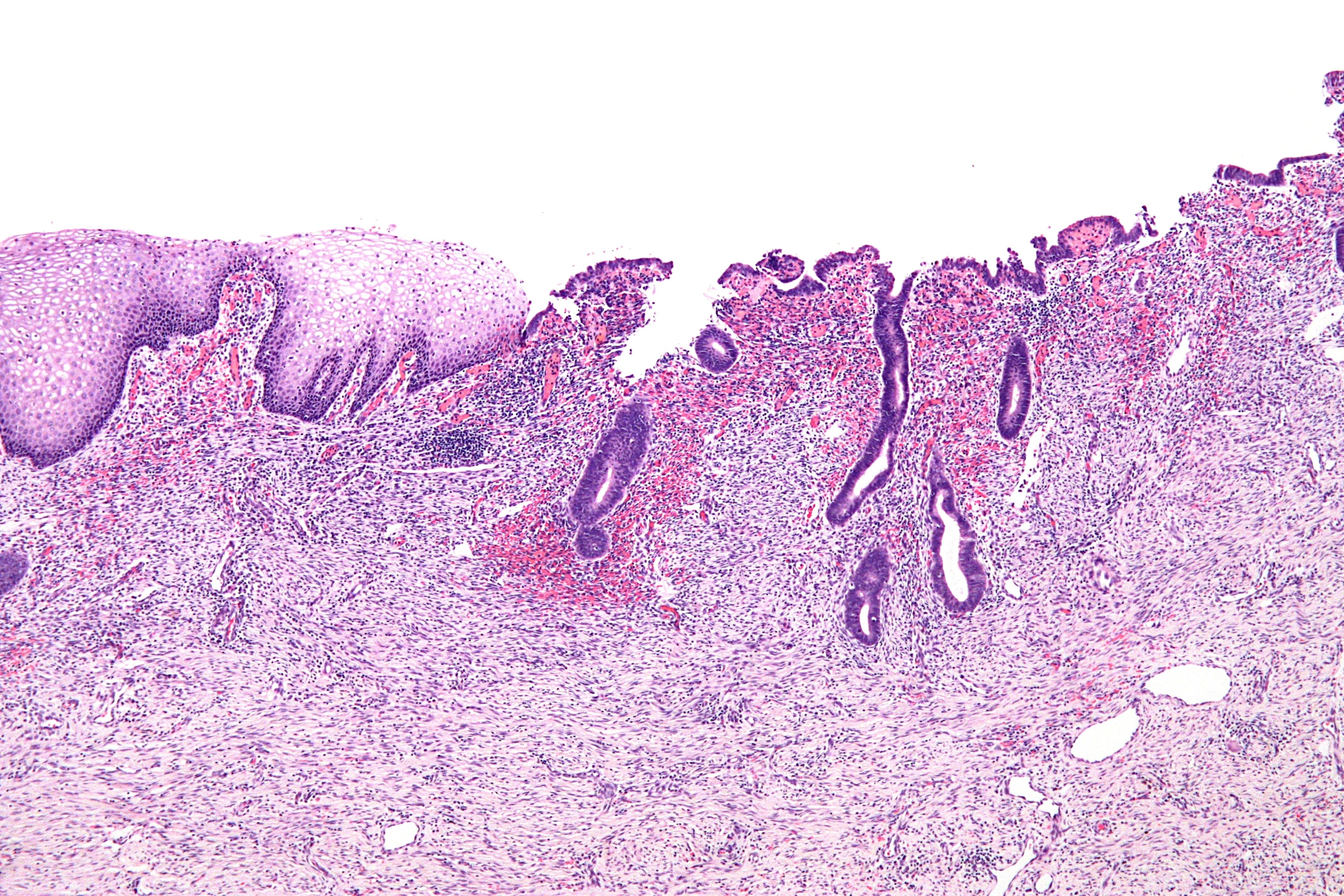 Endometriosis