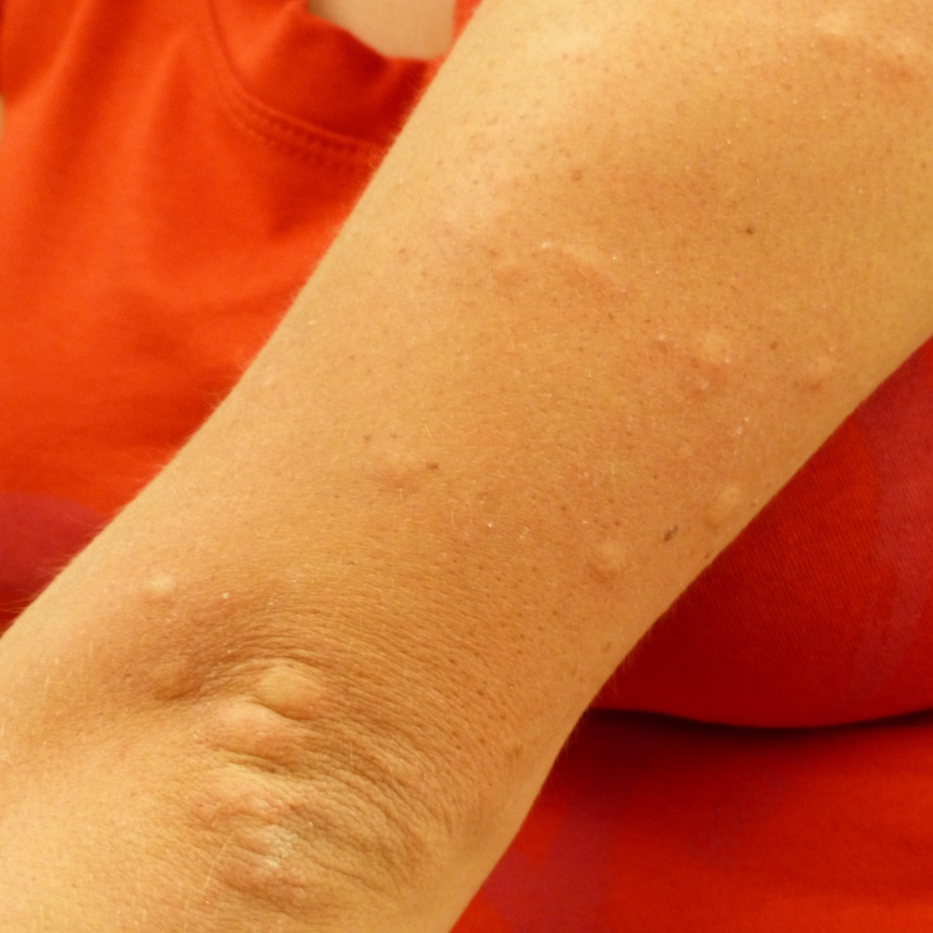 Troben com afecta la Covid-19 a la pell dels malalts