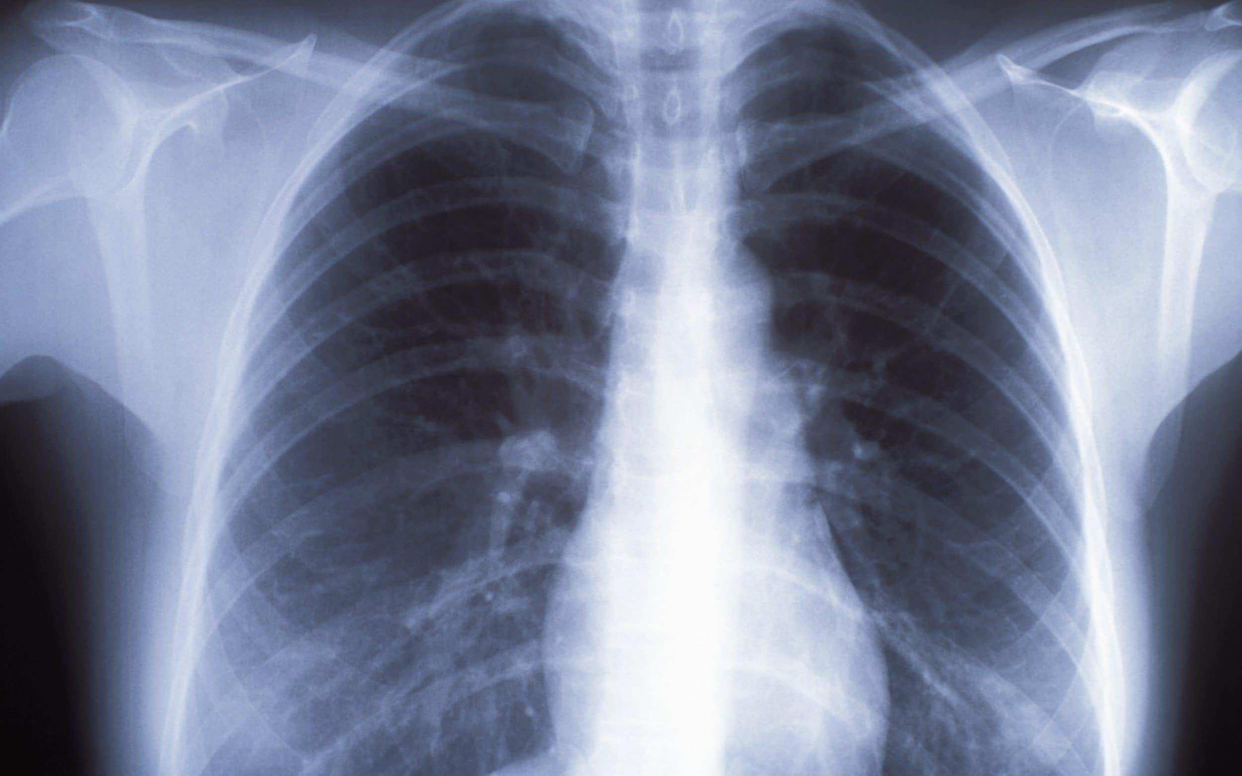 Rajos X pulmons