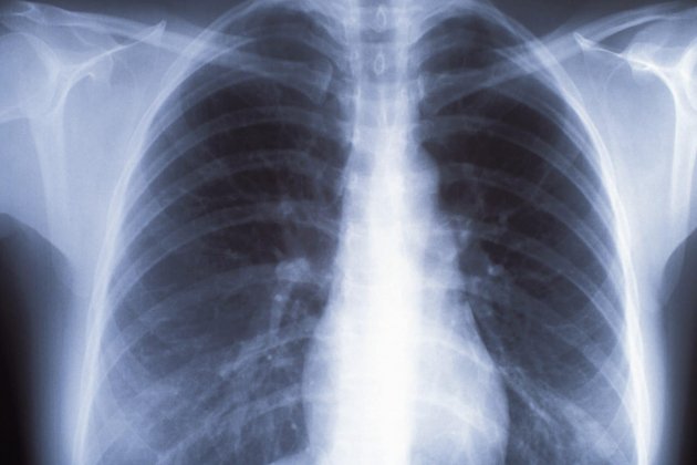 Rayos X pulmones / Archivo