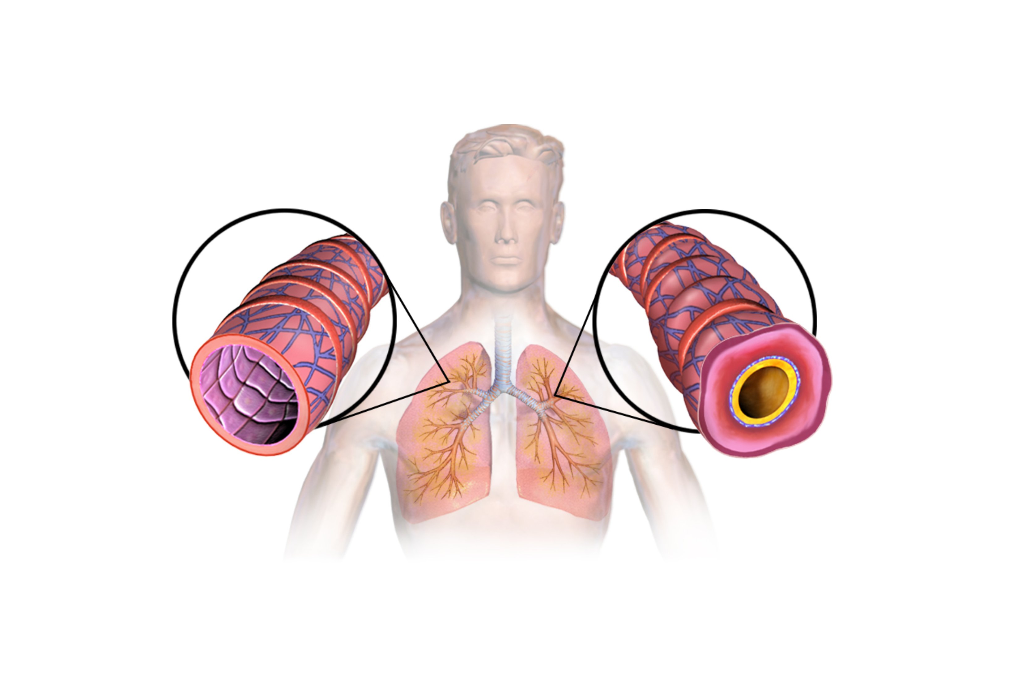 Asma en los pulmones