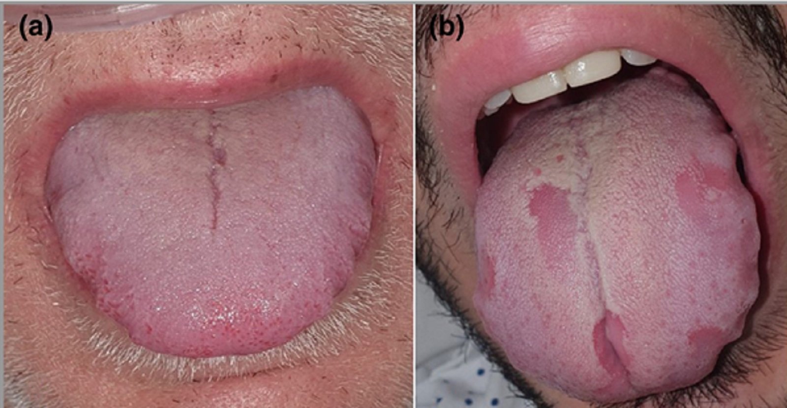 La lengua puede revelar si tienes coronavirus