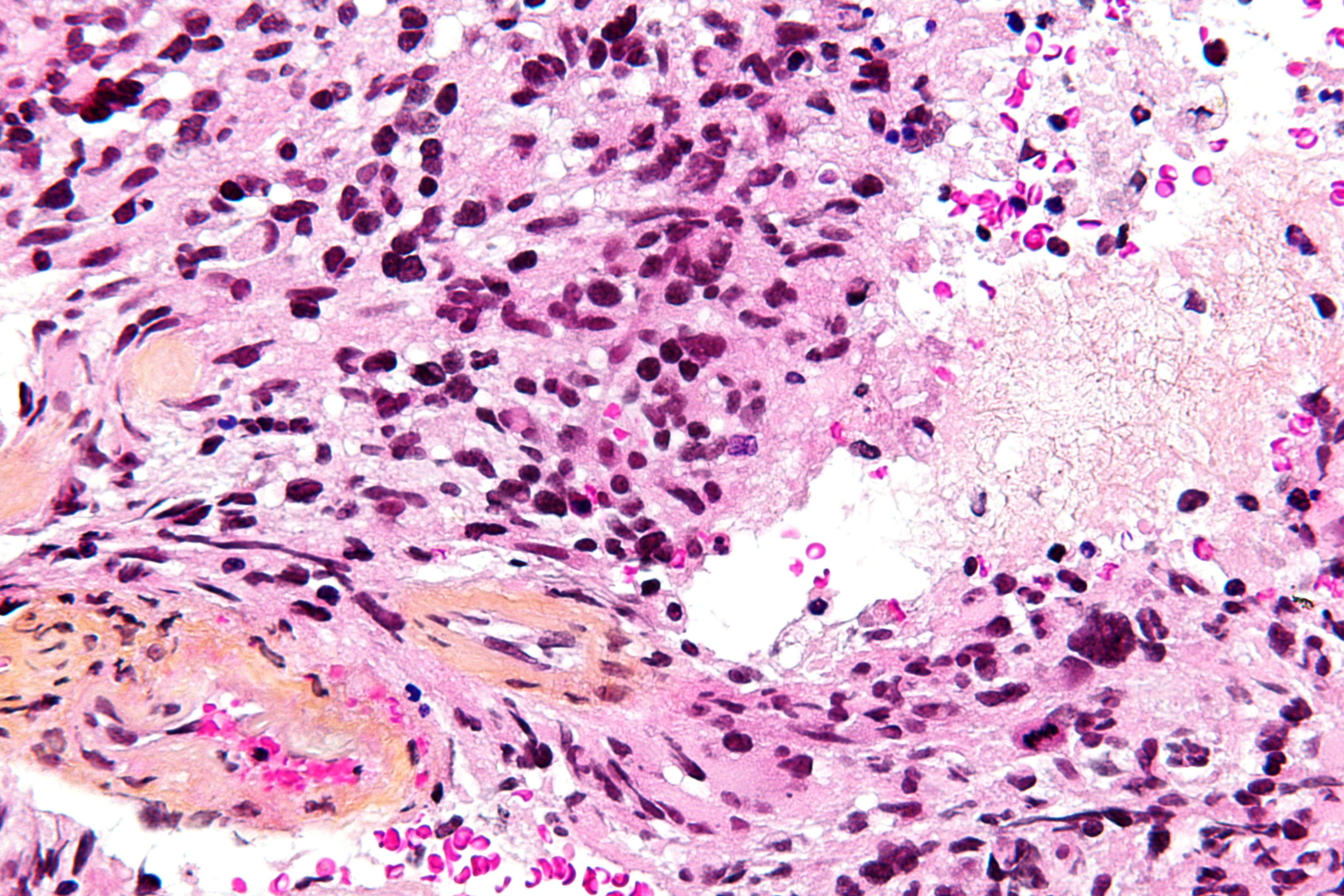 Imatge de glioblastoma