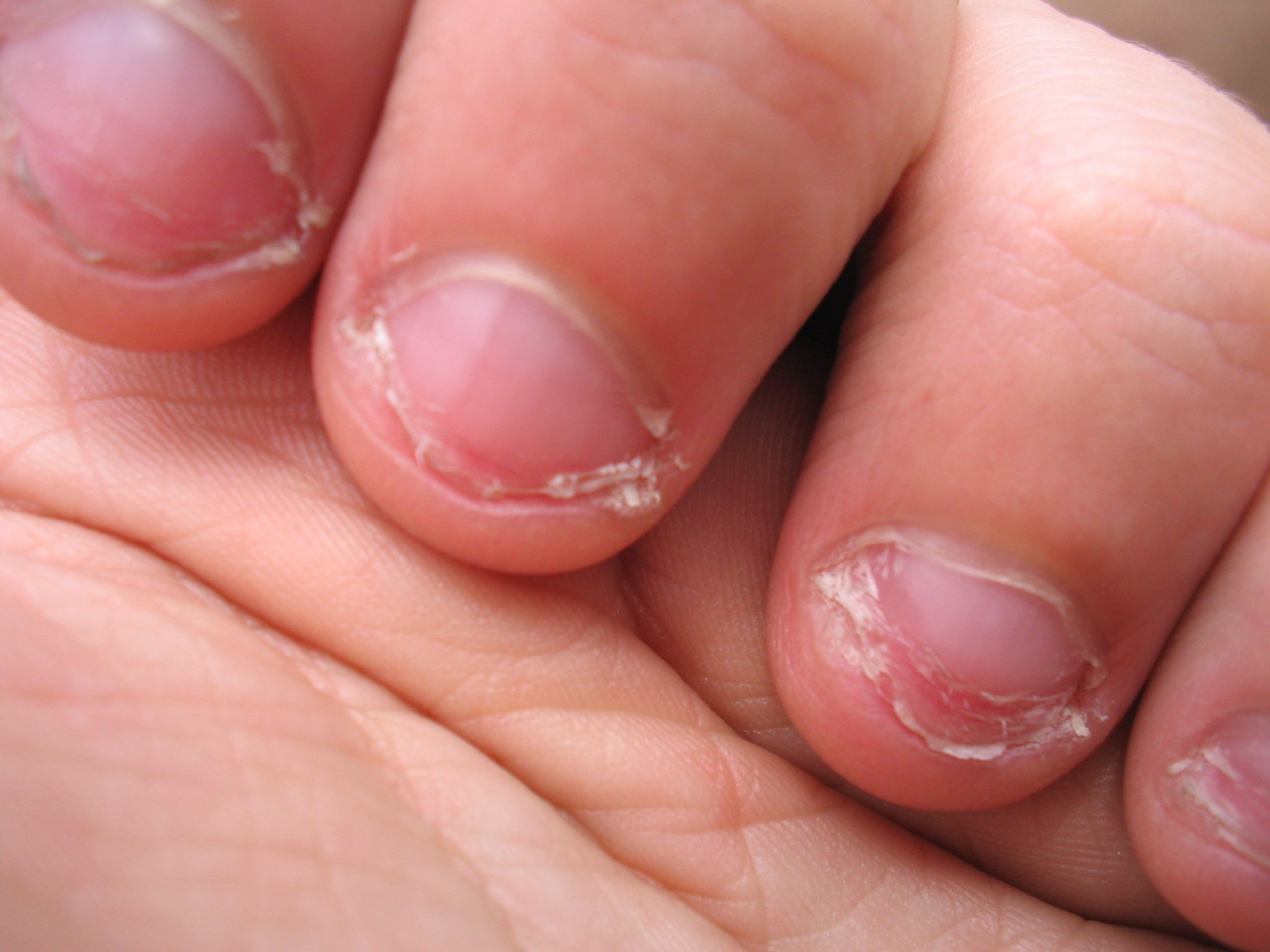 Uñas mordidas