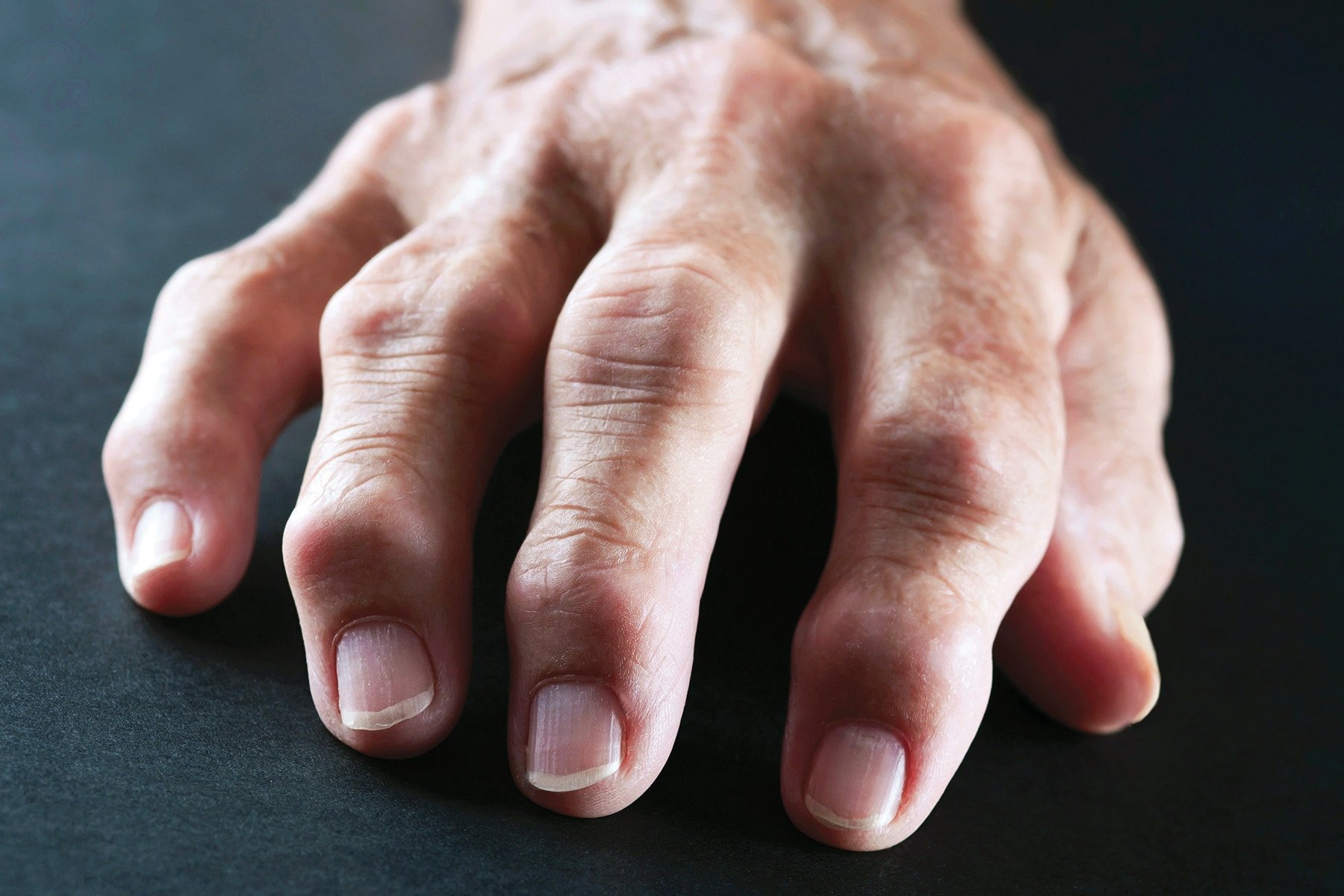 Mano artritis reumatoide