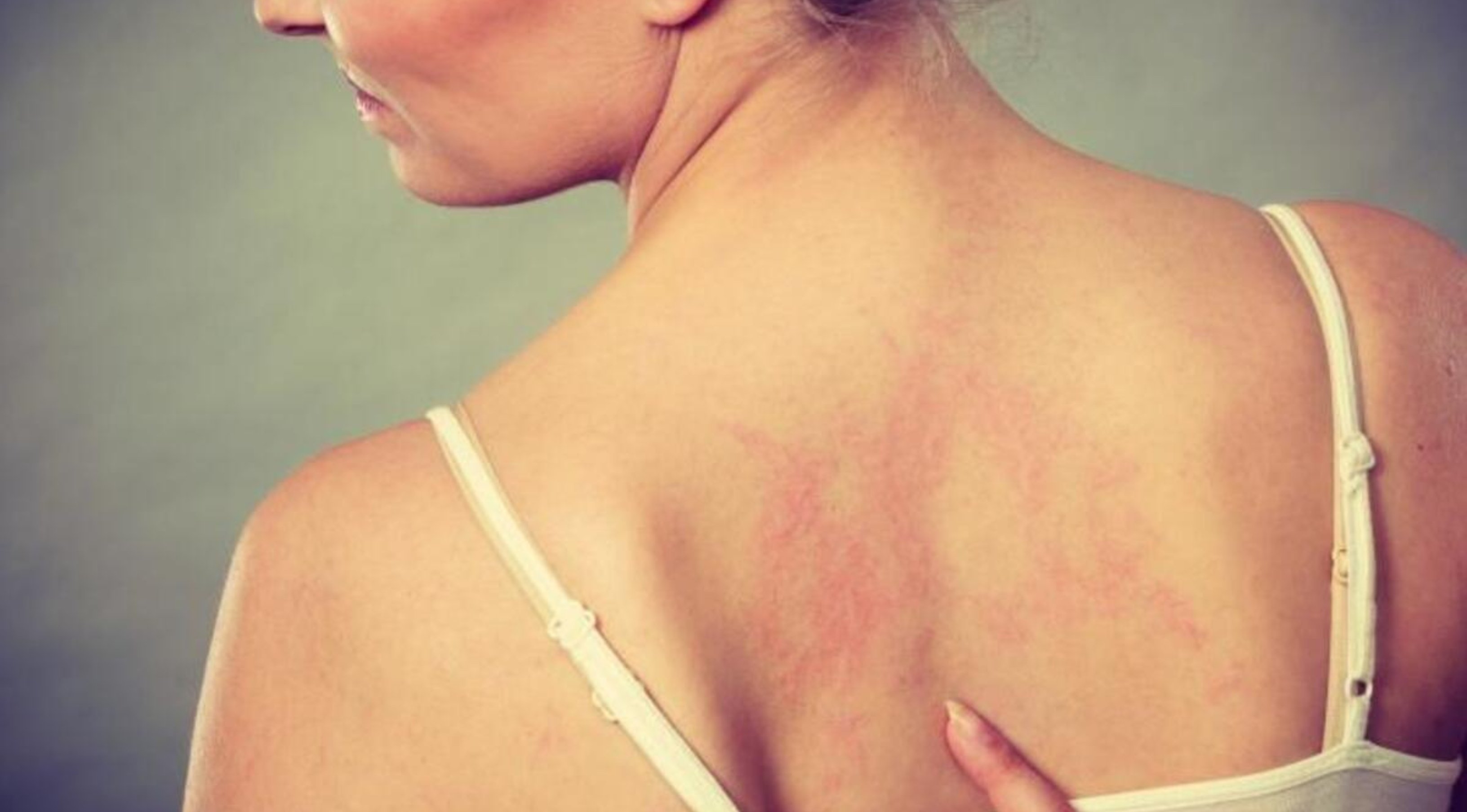 Eczema dermatitis