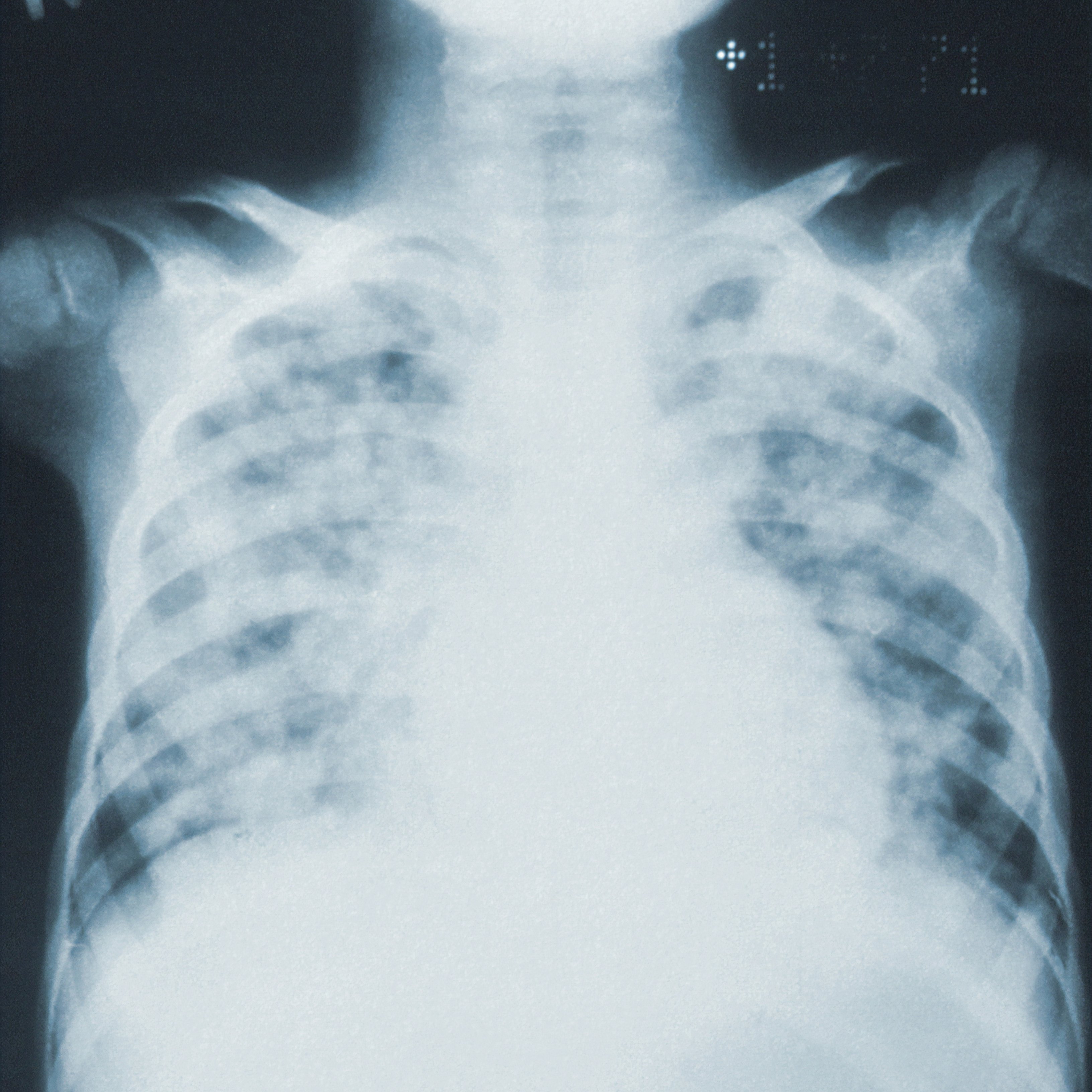 Què diferencia la Covid-19 d'altres malalties infeccioses al pulmó