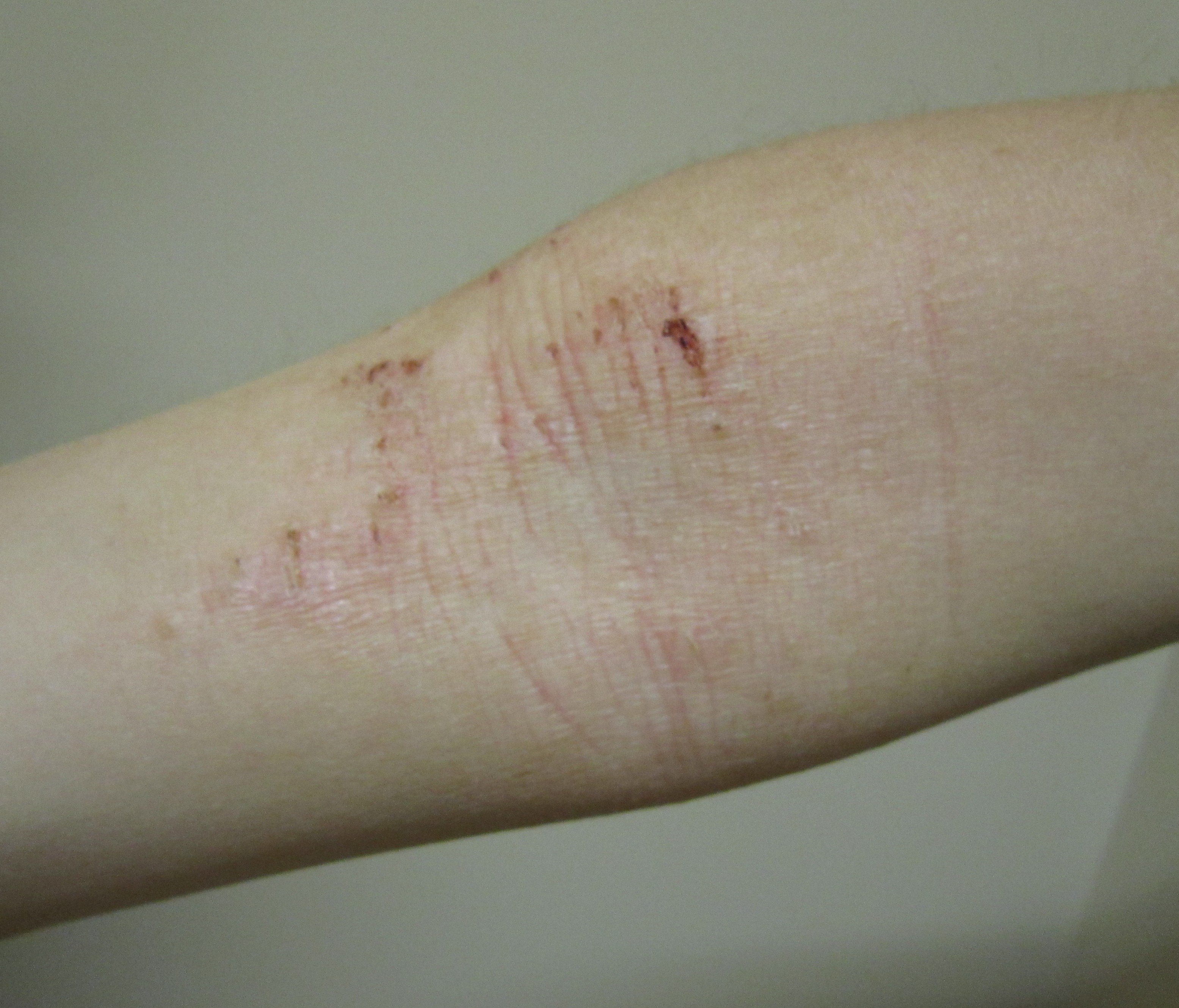 Brazo con dermatitis