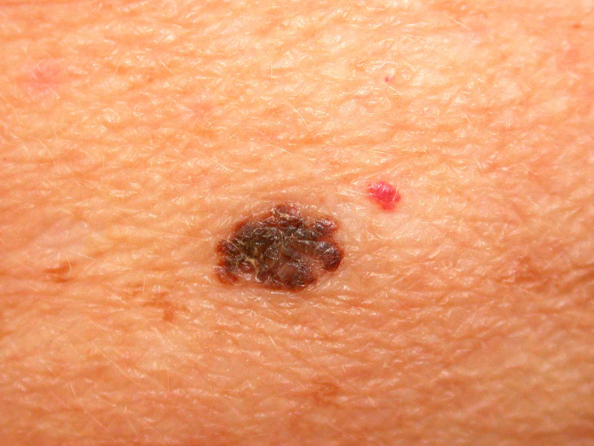 Melanoma