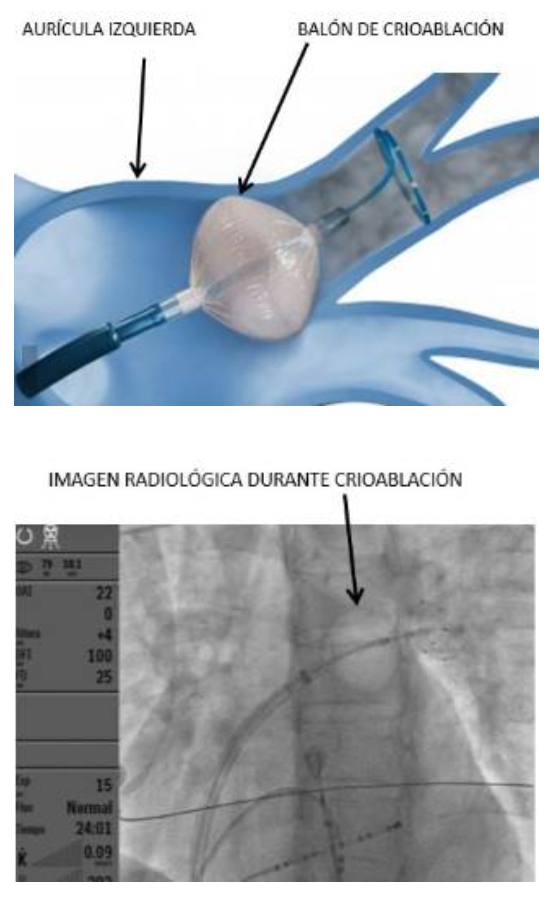 Crioablación de venes pulmonars