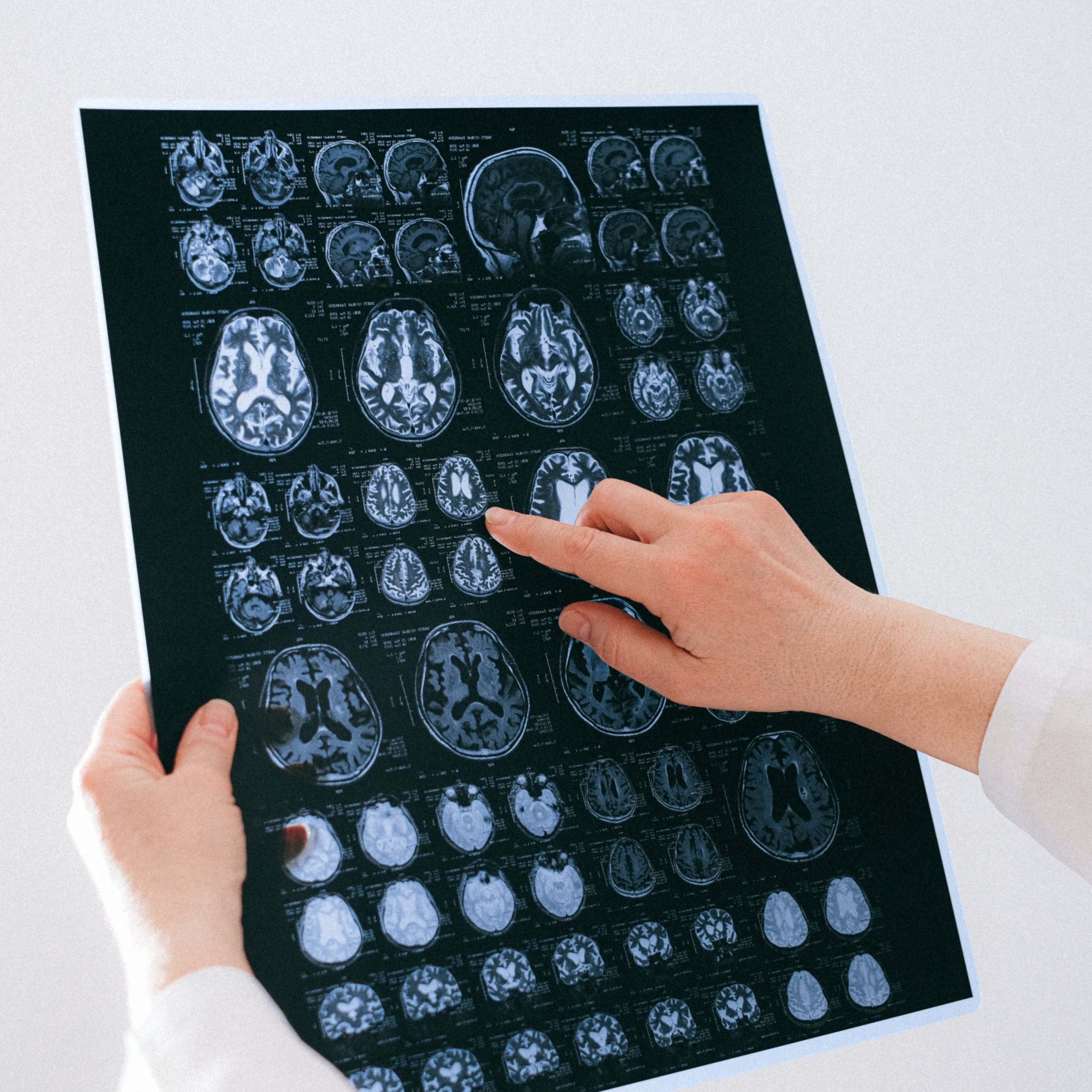 Un nou mapatge cerebral per veure el perquè dels trastorns neuropsiquiàtrics