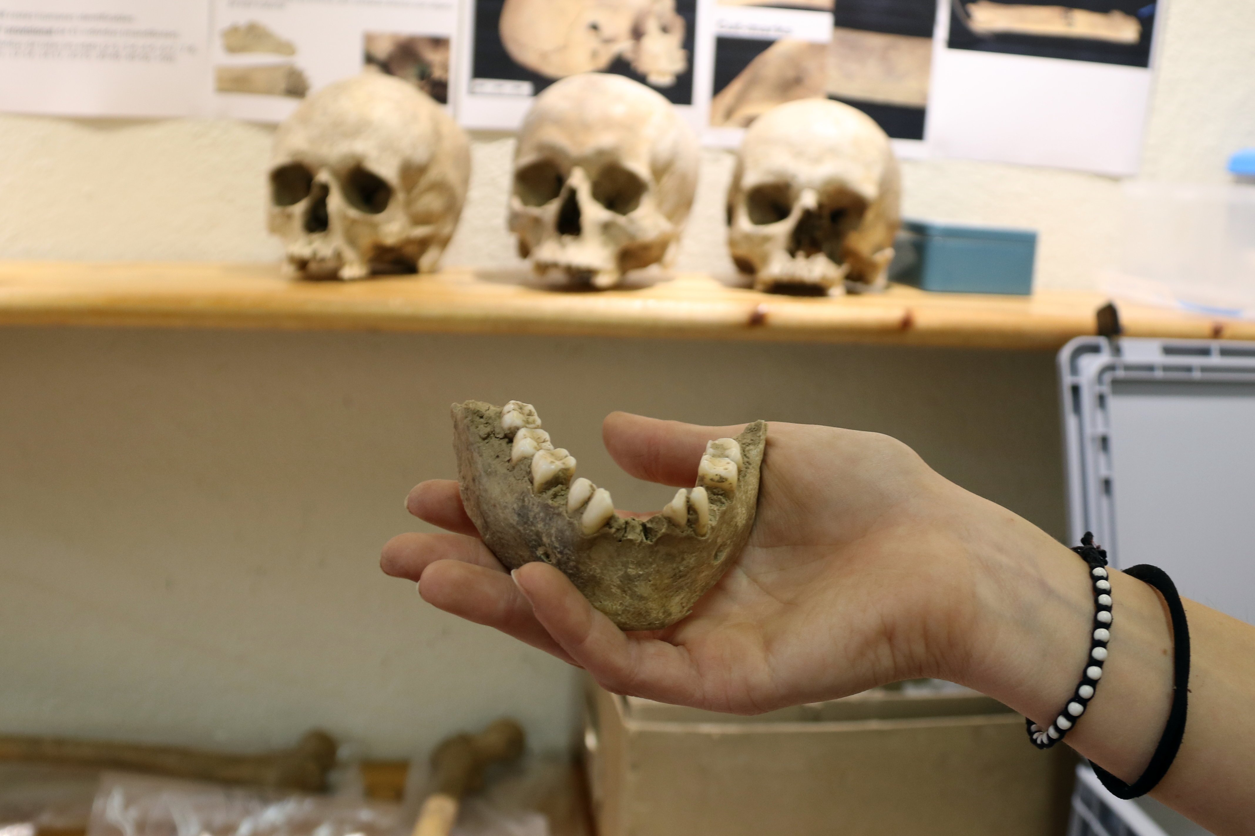 jaciment mandibula ACN