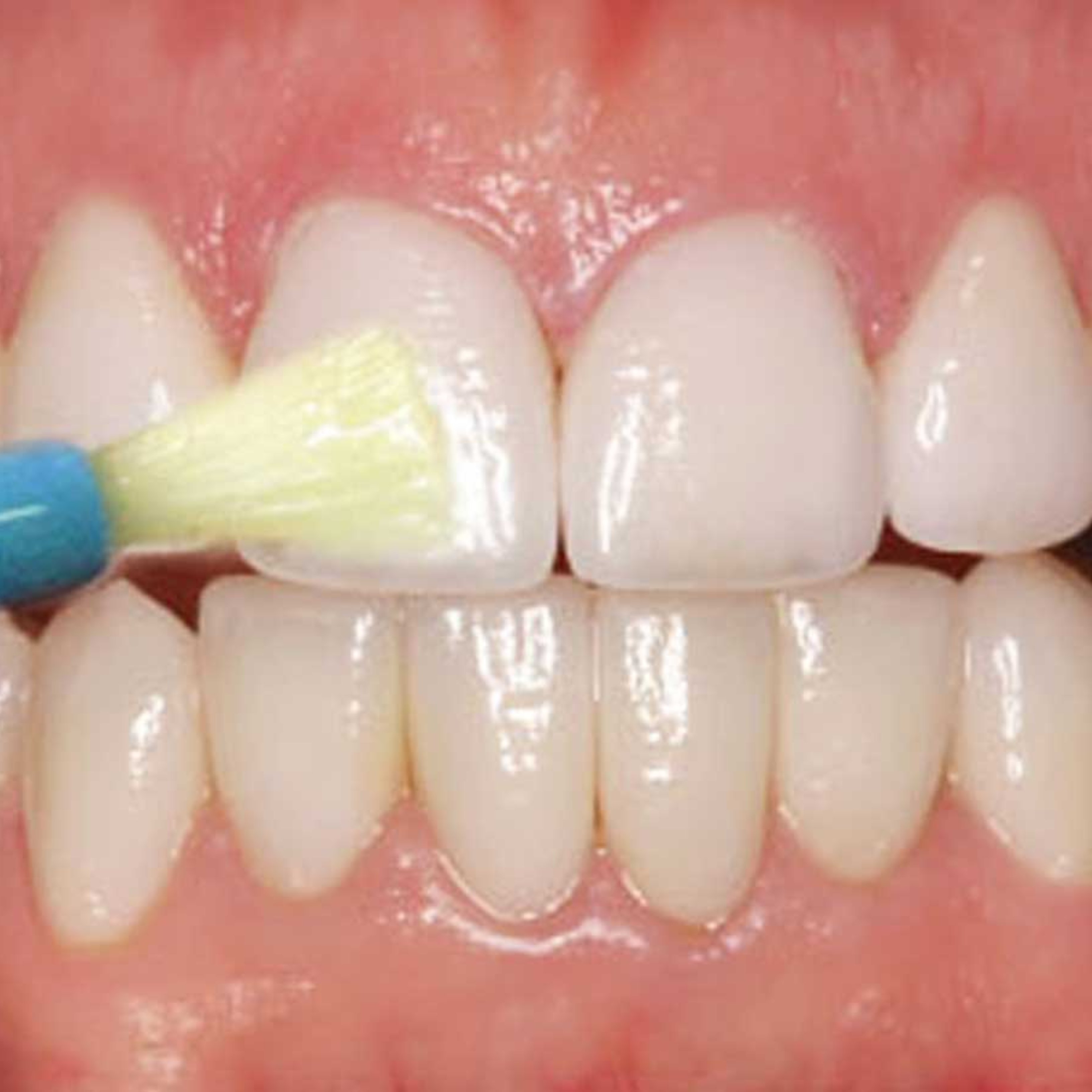 Per què els nens s'haurien d'aplicar vernissos de fluor a les dents