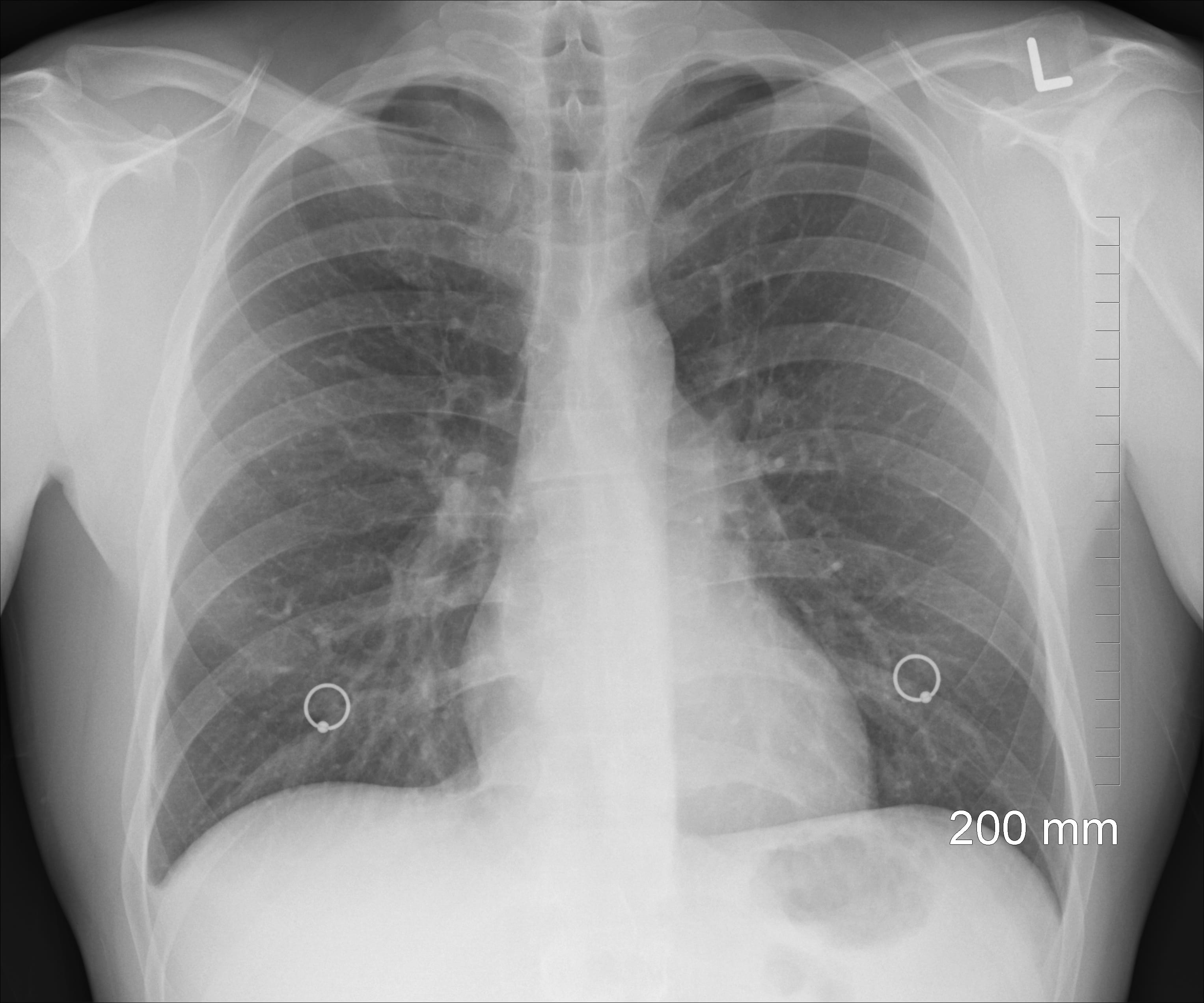 Radiografía pulmones