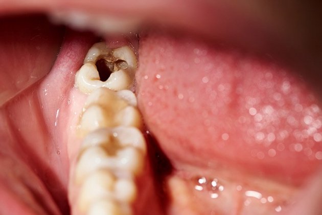 Los carbohidratos son los principales responsables de nuestras caries / Foto: BQDC