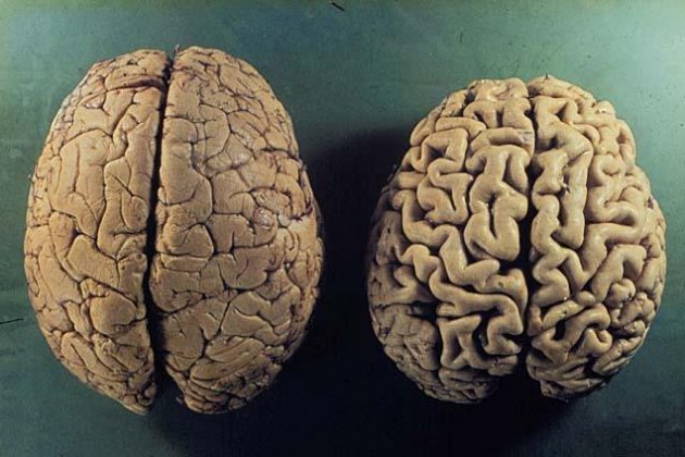 Cervell d’un individu sa (esquerra) i cervell d’un individu amb alzheimer (dreta) / Foto: Reddit
