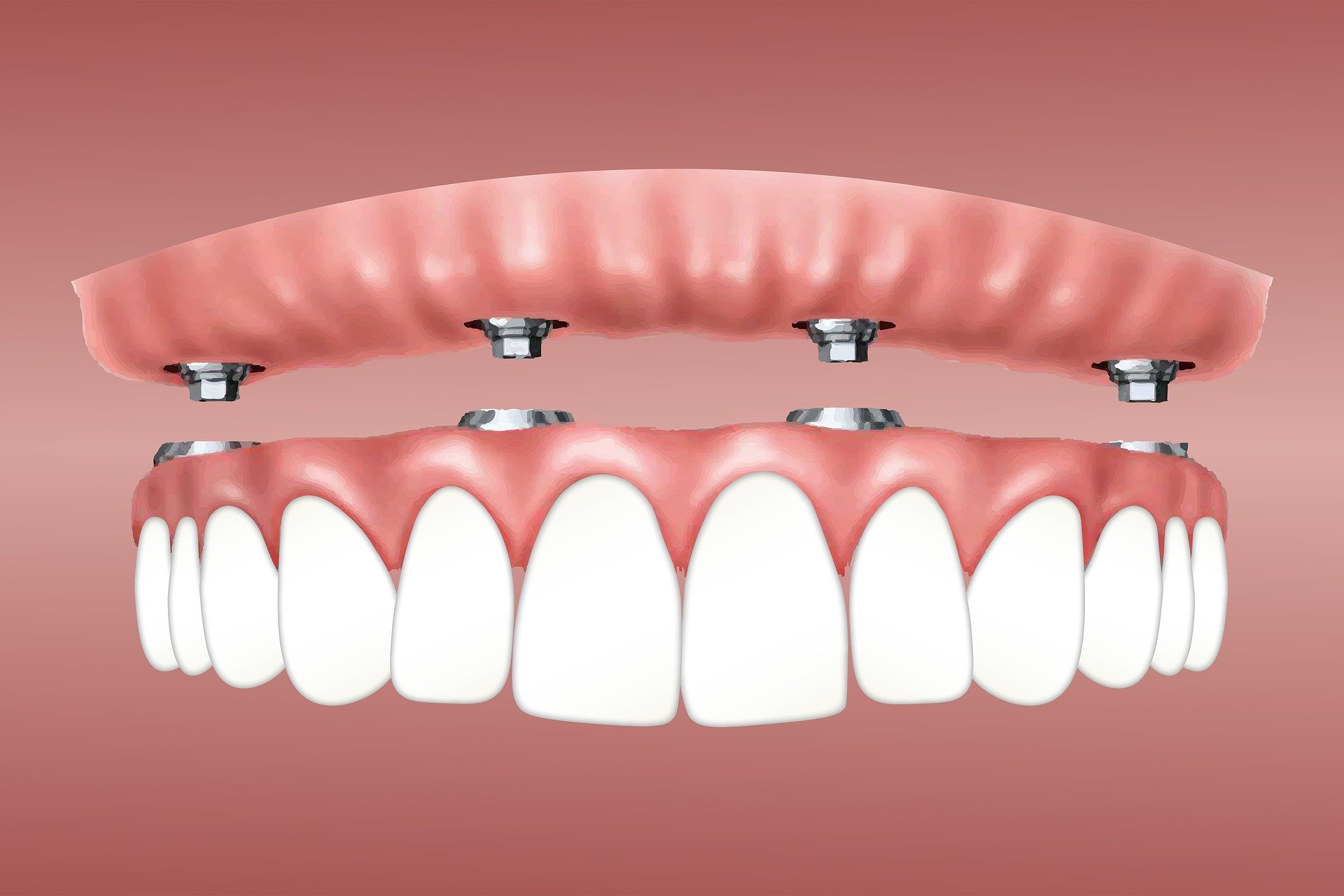 Dentadura implant