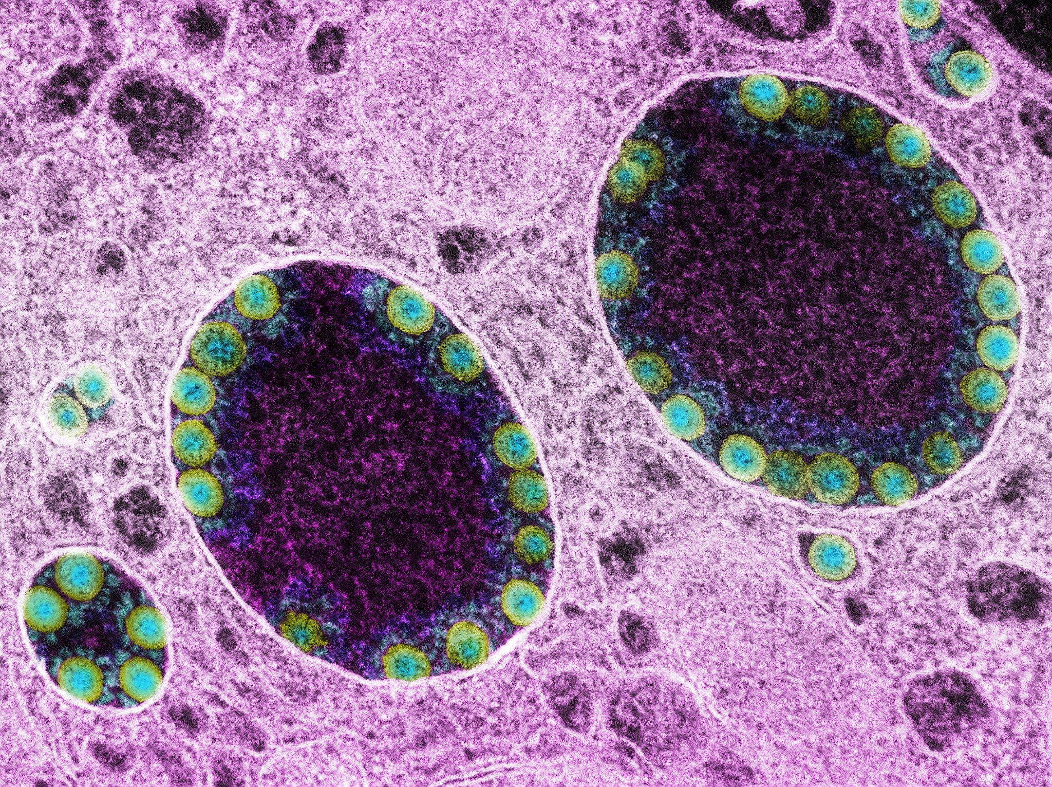 Nova variant de la covid al Regne Unit: podria ser més contagiosa que la delta