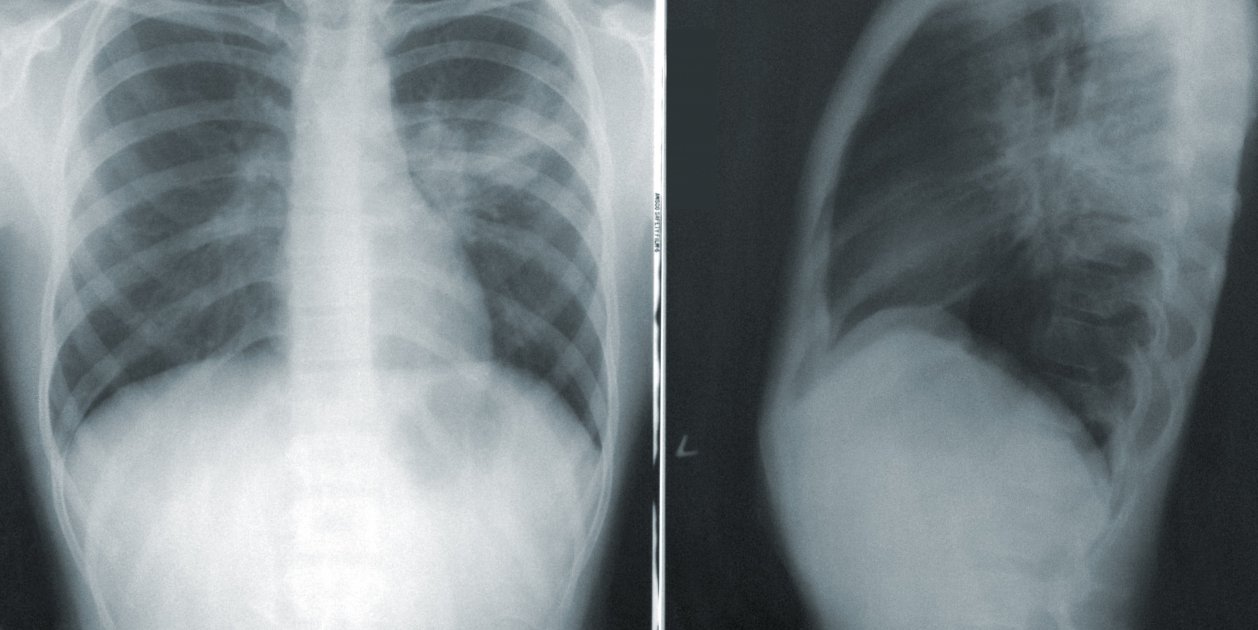 radiografia pulmon unsplash radiografia pulmon unsplash