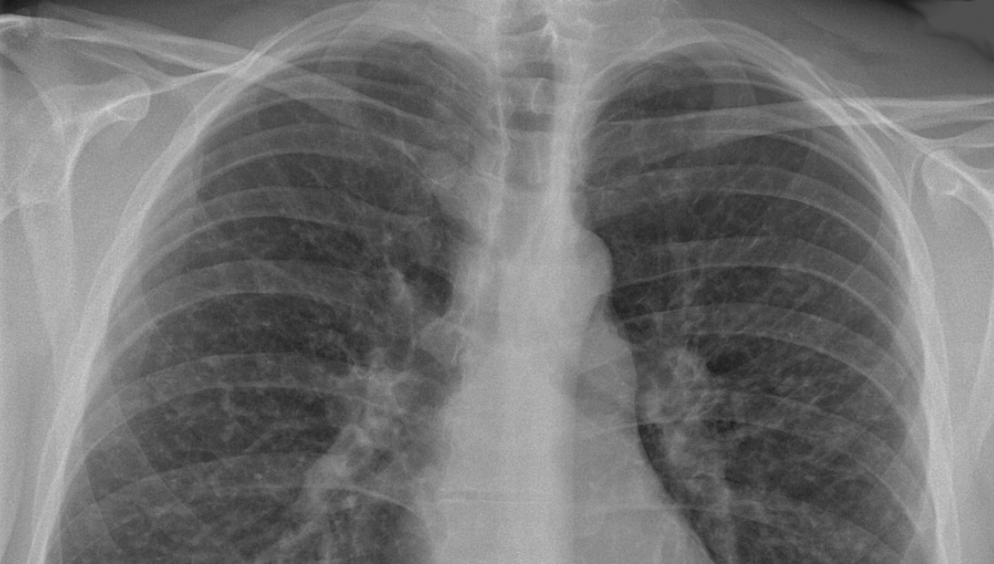 Radiografía pulmones