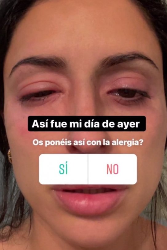 Inma Campano reacción alérgica Telecinco