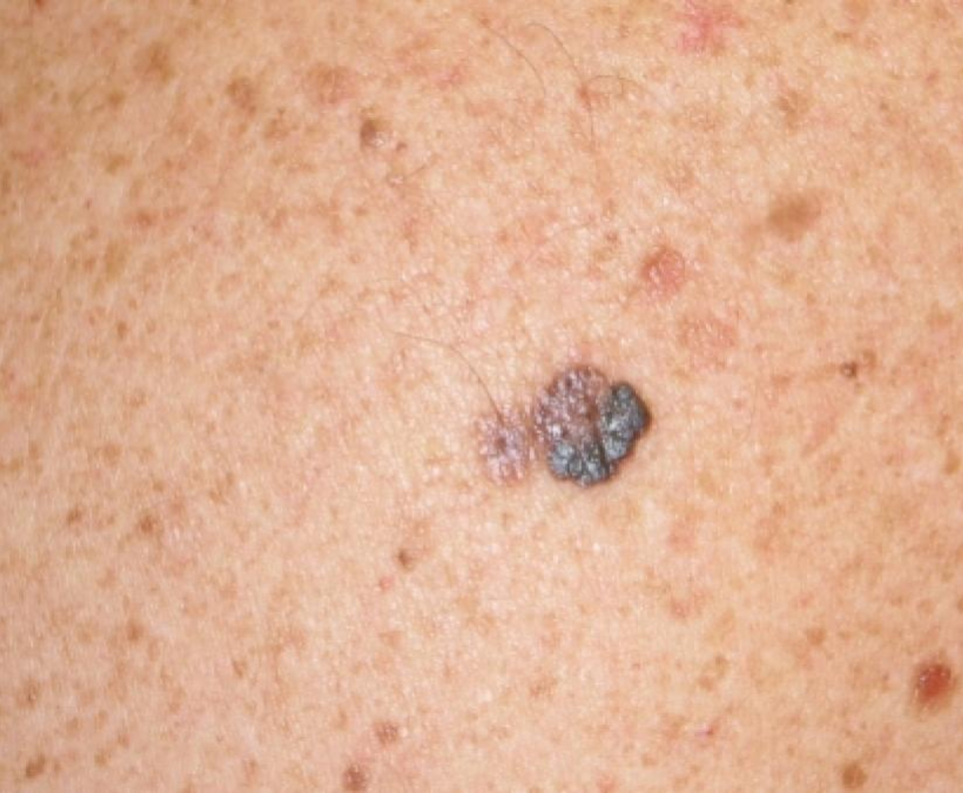 Melanoma