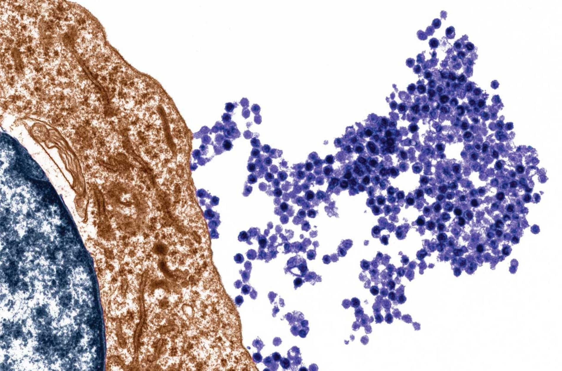 El virus de la mononucleosi, principal causa de l'esclerosi múltiple