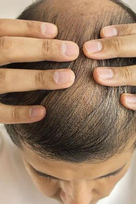 Caída de pelo