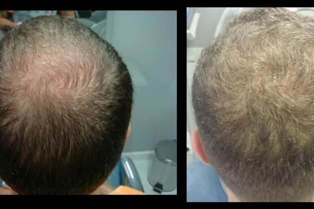 Tratamientos de células madre para recuperar el pelo